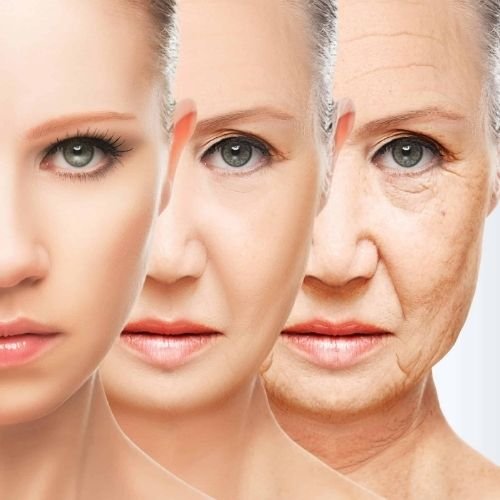 Melasma